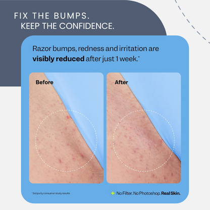 K-Beauty Ingrown Hair & Dark Spot Treatment Roller